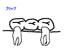ブリッジ