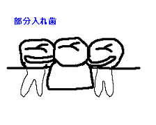 部分入れ歯