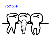 インプラント