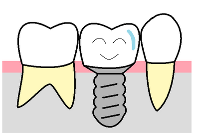 implant4.png